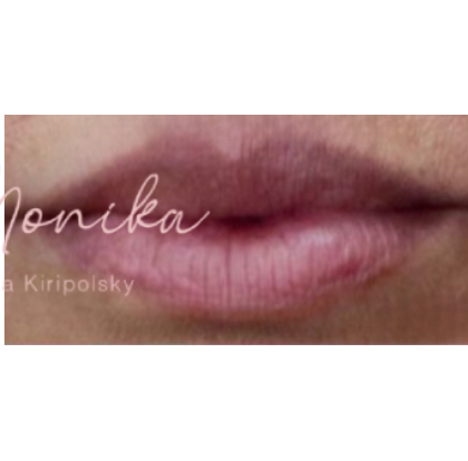 Lip Filler Before & After Patient #560