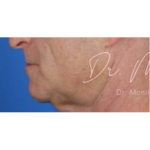 Chin & Jawline Facial Rebalancing Before & After Patient #577