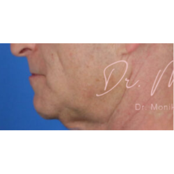 Chin & Jawline Facial Rebalancing Before & After Patient #577