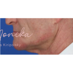 Chin & Jawline Facial Rebalancing Before & After Patient #577