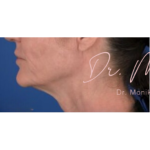 Chin & Jawline Facial Rebalancing Before & After Patient #578