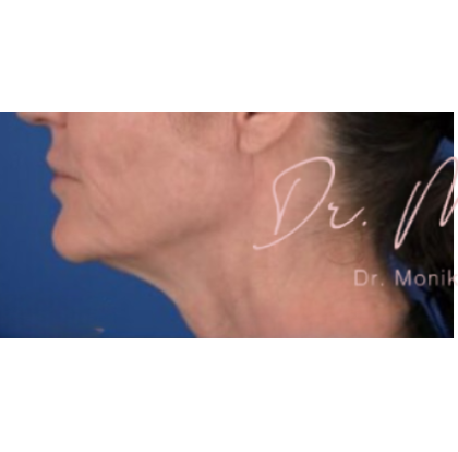 Chin & Jawline Facial Rebalancing Before & After Patient #578