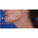 Chin & Jawline Facial Rebalancing Before & After Patient #578