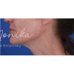 Chin & Jawline Facial Rebalancing Before & After Patient #578