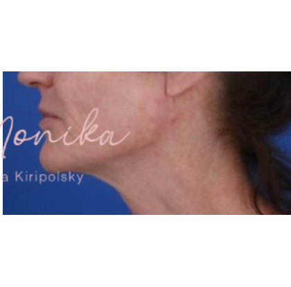 Chin & Jawline Facial Rebalancing Before & After Patient #578