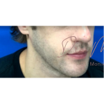 Chin & Jawline Facial Rebalancing Before & After Patient #580