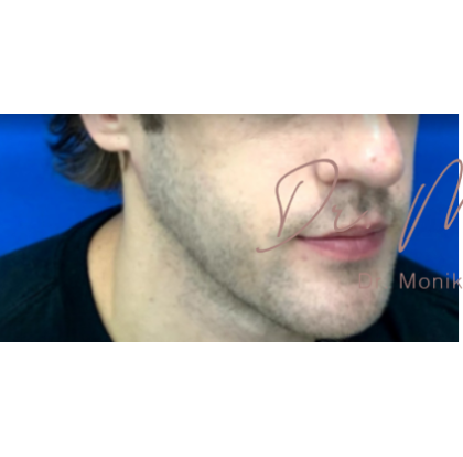 Chin & Jawline Facial Rebalancing Before & After Patient #580