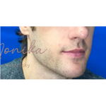 Chin & Jawline Facial Rebalancing Before & After Patient #580