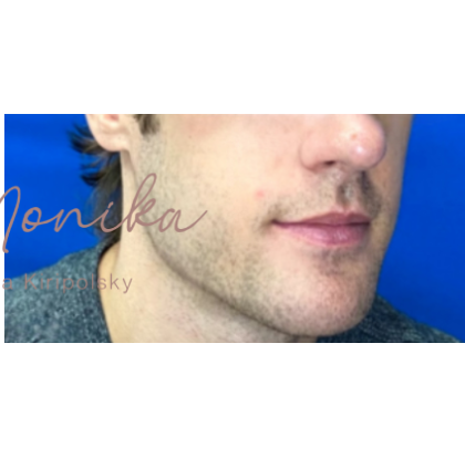 Chin & Jawline Facial Rebalancing Before & After Patient #580