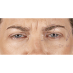 Botox Before & After Patient #602