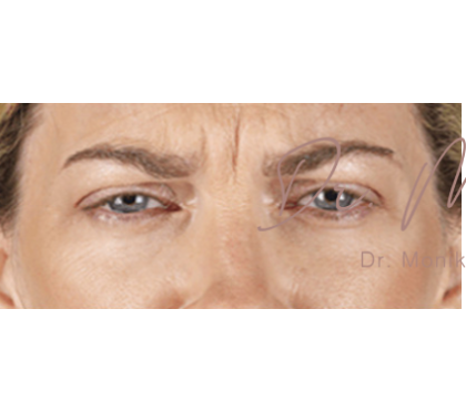 Botox Before & After Patient #602