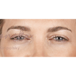 Botox Before & After Patient #602