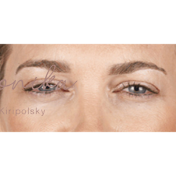 Botox Before & After Patient #602