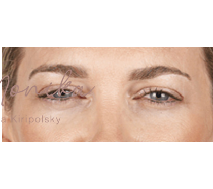 Botox Before & After Patient #602