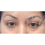 Botox Before & After Patient #603