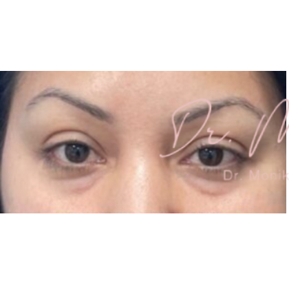 Botox Before & After Patient #603