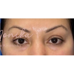 Botox Before & After Patient #603