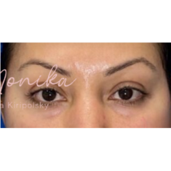 Botox Before & After Patient #603