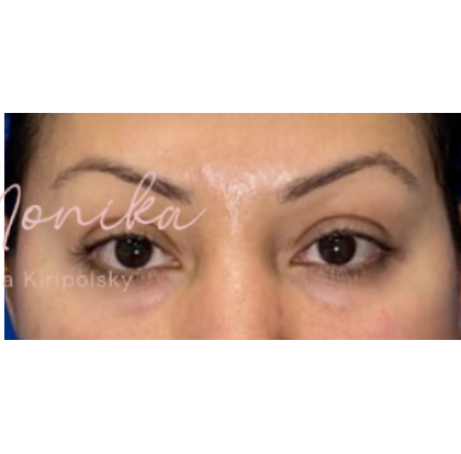 Botox Before & After Patient #603