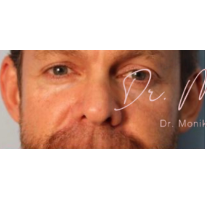 Botox Before & After Patient #605
