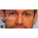 Botox Before & After Patient #605