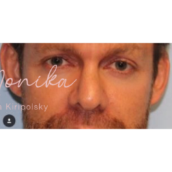 Botox Before & After Patient #605