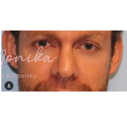 Botox Before & After Patient #605