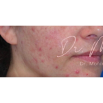 Acne Scarring Before & After Patient #619