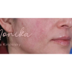 Acne Scarring Before & After Patient #619