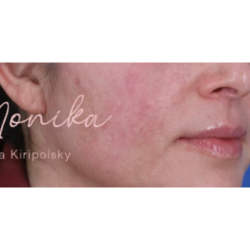 Acne Scarring Before & After Patient #619