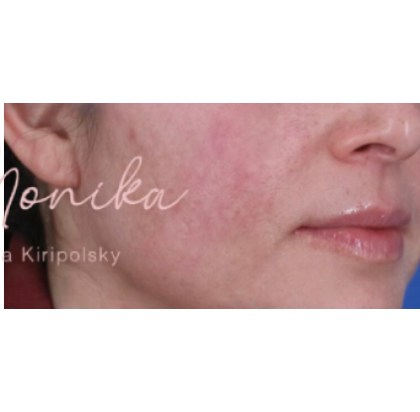 Acne Scarring Before & After Patient #619