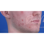 Acne Scarring Before & After Patient #620