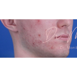 Acne Scarring Before & After Patient #620