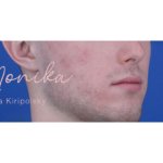 Acne Scarring Before & After Patient #620