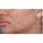 Acne Scarring Before & After Patient #623