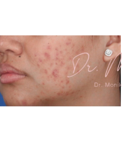 Acne Scarring Before & After Patient #623