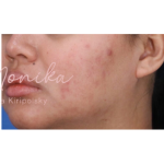 Acne Scarring Before & After Patient #623