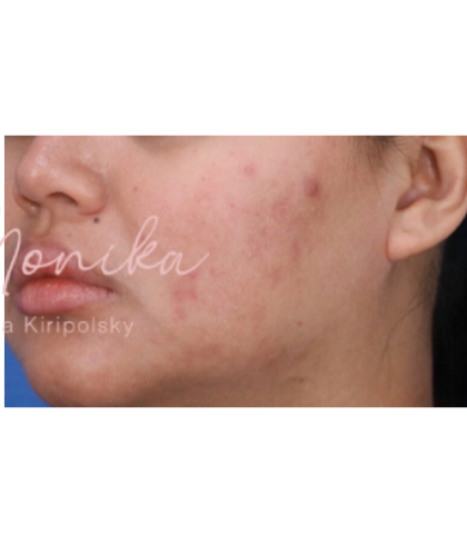 Acne Scarring Before & After Patient #623