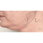 Submental Fat Removal Before & After Patient #643