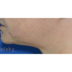 Submental Fat Removal Before & After Patient #643
