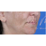 Melasma Before & After Patient #651