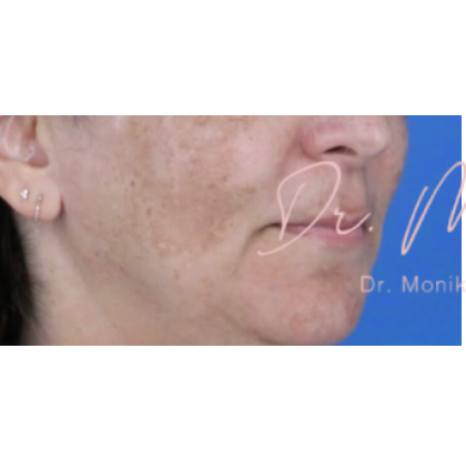 Melasma Before & After Patient #651
