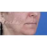 Melasma Before & After Patient #651