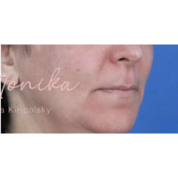 Melasma Before & After Patient #651