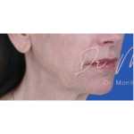 Thread Lifts Before & After Patient #659