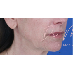 Thread Lifts Before & After Patient #659