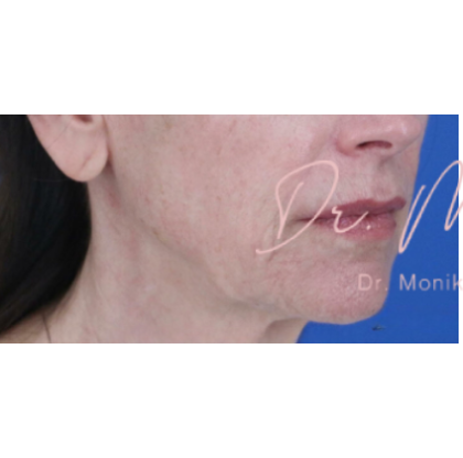 Thread Lifts Before & After Patient #659