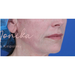 Thread Lifts Before & After Patient #659