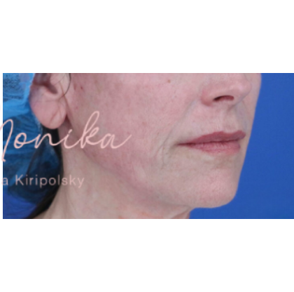 Thread Lifts Before & After Patient #659