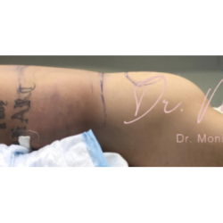Fat Transfer Before & After Patient #663